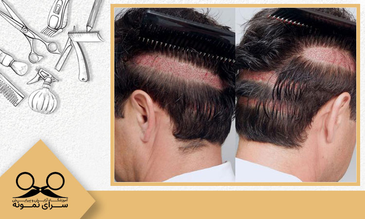 عوارض کشت مو چیست؟ پاسخ در سایت هیرآکادمی
