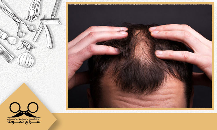 ریزش موی فصلی چه مدت طول می کشد؟