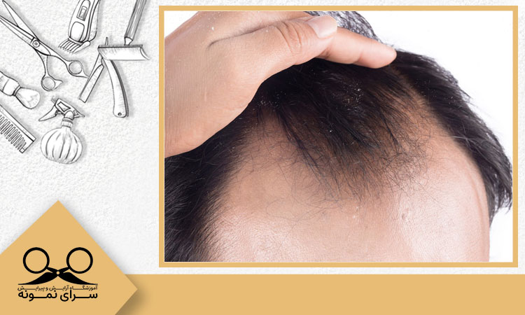 جلوگیری از ریزش مو در مردان