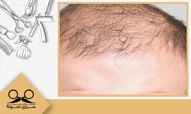 درمان بلند کردن موی مردانه