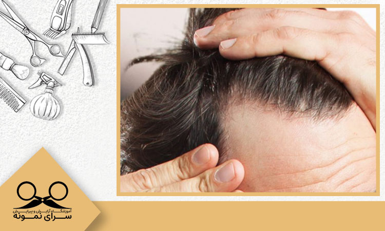 تاثیرات استرس بر مو آقایان